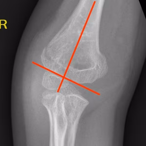Baumanns angle paediatric elbow