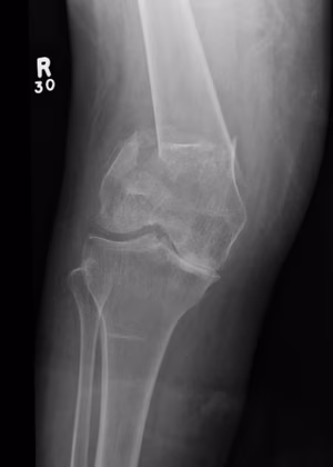 Distal Femur Replacement 1