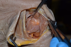 Posterior shoulder approach