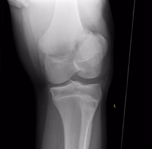 Distal Femur Salter Harris 2