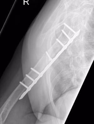 Proximal humerus ORIF