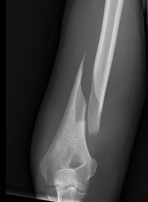 Holstein Lewis fracture
