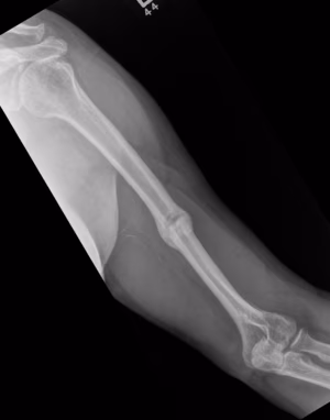 Humerus shaft 4