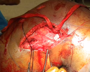 PLC Pass Popliteus Tendon deep to fascia