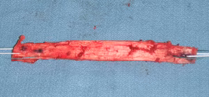 ACL BPTB Graft 2