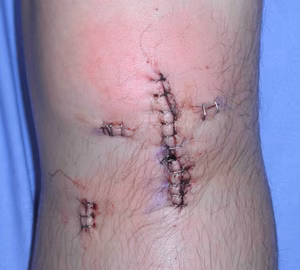 ACL BPTB Incisions