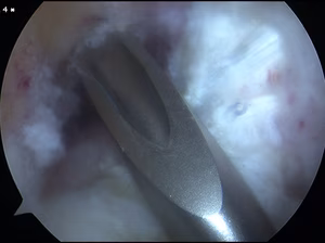 ACL Femoral Offset Guide