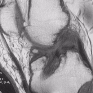 ACL Graft Rupture MRI Sagittal