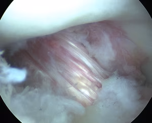 ACL No Impingment full extension
