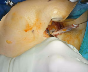 Over the top ACL Fixation 7