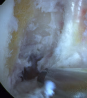 ACL Post Notchplasty