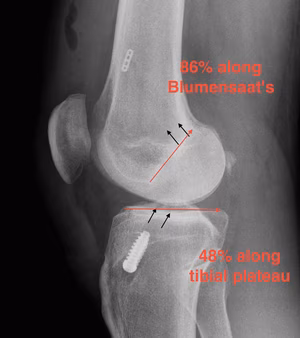 ACL Reconstruction Sagittal Tunnel Measurement