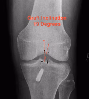 ACL Reconstruction Graft Inclination Measurement
