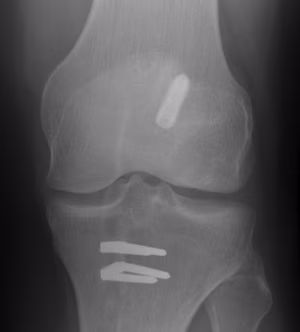 ACL Graft Rupture Graft Too Vertical