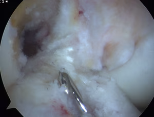 Tibial Beath Pin