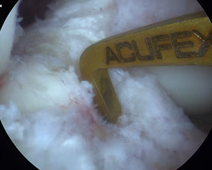 ACL Tibial Guide