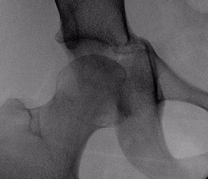 Acetabular Fracture Post Steinman Pin