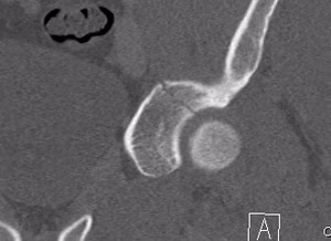 Acetabular Fracture Undisplaced