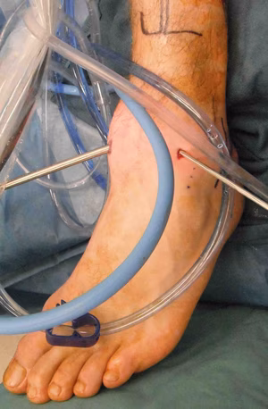 Ankle Arthroscopy