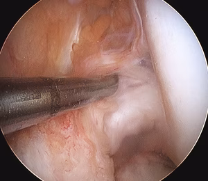 ACL Partial Torn Arthrocopy