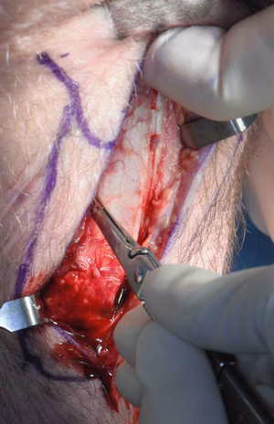 BPTB Lateral Cut