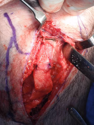 BPTB Patella Bone