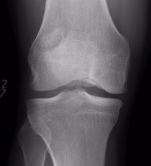 Bipartite patella