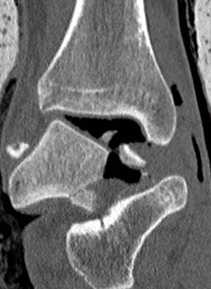 CT Talar Dome Fracture 2