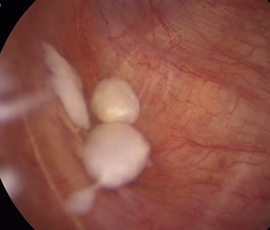Secondary Synovial Chondromatosis