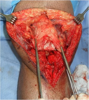 Chronic Patella Tendon Rupture 2