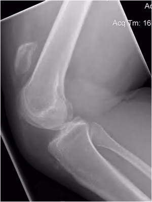 Chronic Patella Tendon Rupture Xray