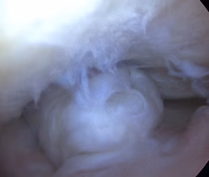 ACL Graft Cyclops Lesion