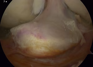 Cyclops Lesion