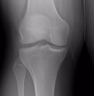 Discoid Meniscus Flattened Condyle Widened Joint Space