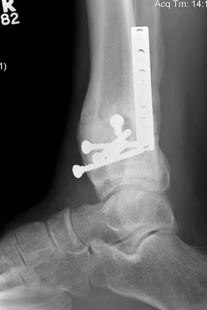 Distal Tibial Malunion Lateral