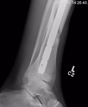 Distal Tibial Nail Lateral