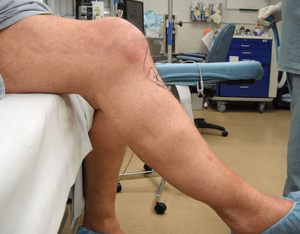 Extensor Lag
