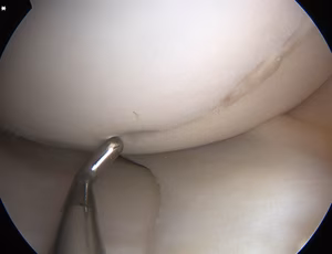 Femoral OCD Type 2 Arthroscopic