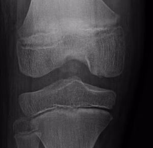Femoral OCD