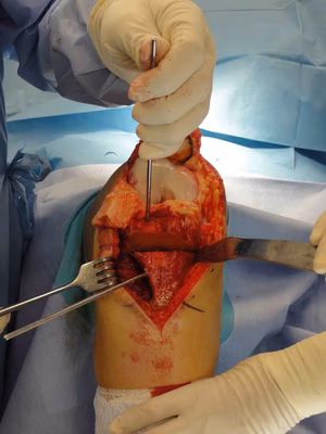 Tibial Derotation Osteotomy
