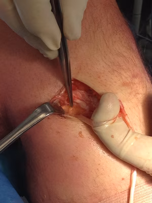 Hamstring 3