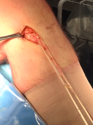 Hamstring 4