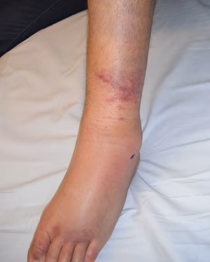 High Ankle Sprain Clinical