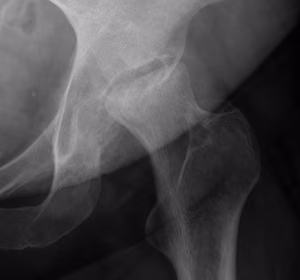 Hip AVN Type 3