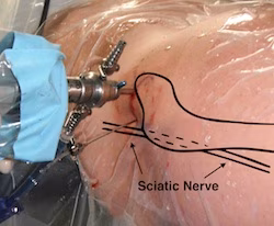 Hip Scope Nerves at Risk 2