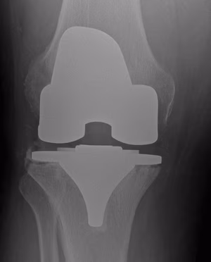 Infected TKR Tibial Lysis