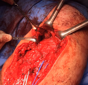 Drill hole ischial tuberosity