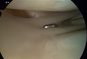 Knee Arthroscopy Popliteus