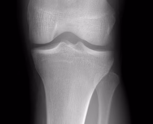 Knee Normal AP