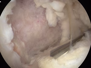 Knee OCD Case 7